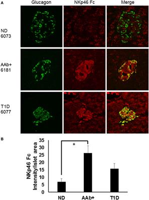 The Four-Way Stop Sign: Viruses, 12-Lipoxygenase, Islets, and Natural Killer Cells in Type 1 Diabetes Progression